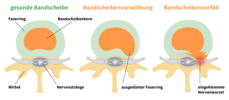 Bandscheibenvorfall Bandscheibenvorwölbung