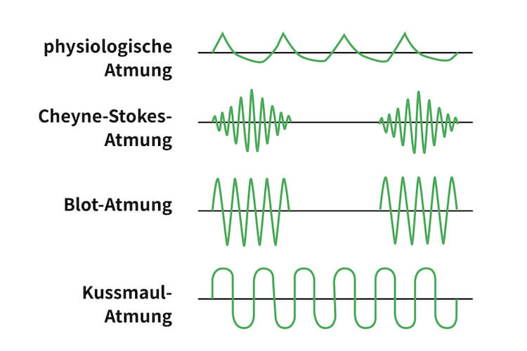 Cheyne-Stokes-Atmung